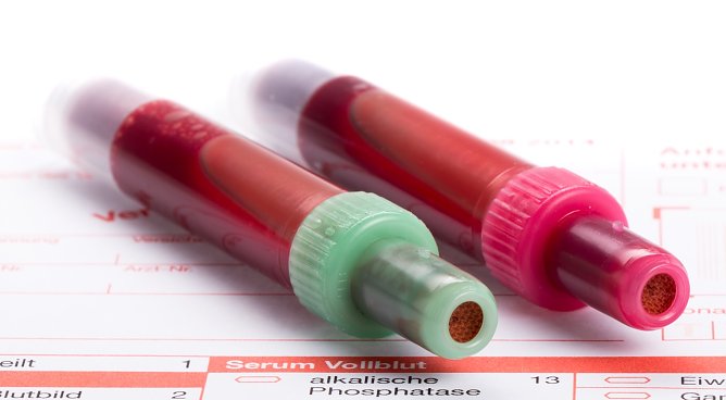 sepsis (Foto: UPD) sepsis (Foto: UPD)